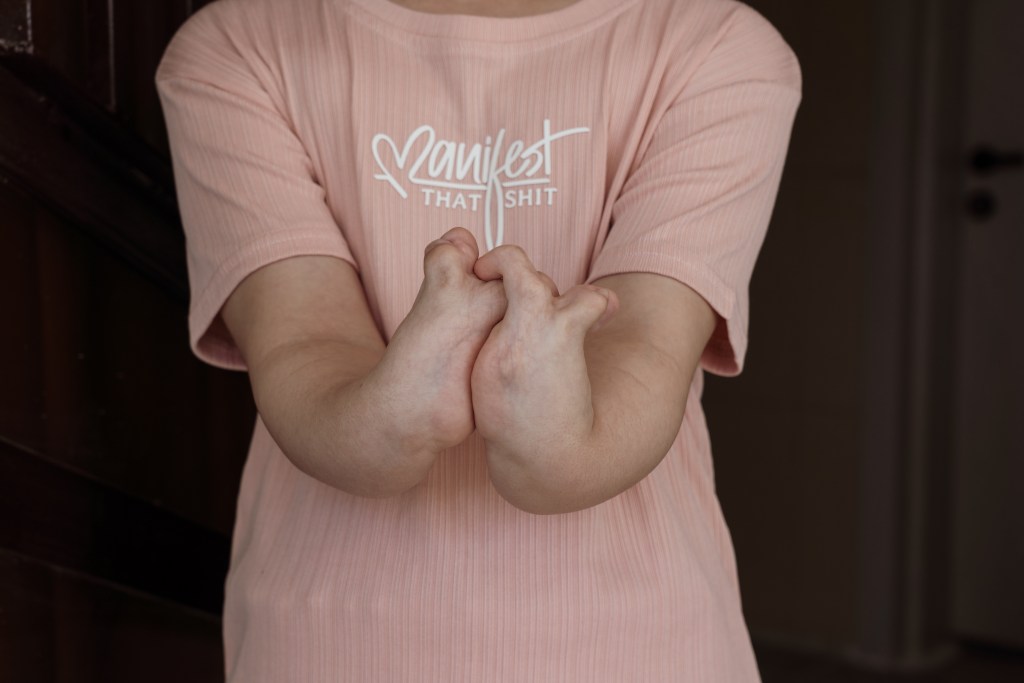 A close-up of Fatema’s arm deformities, one of many cases in Fallujah consistent with the rise in severe birth anomalies that doctors and researchers link to toxic metal contamination from the 2004 assaults. Photo by Jaclynn Ashly.